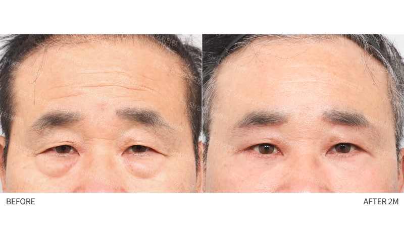 #28 60대 남자 눈성형, 눈물 흘림 이유_ 중년 남자 복합 리프팅 케이스