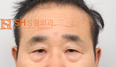 #28 60대 남자 눈성형, 눈물 흘림 이유_ 중년 남자 복합 리프팅 케이스