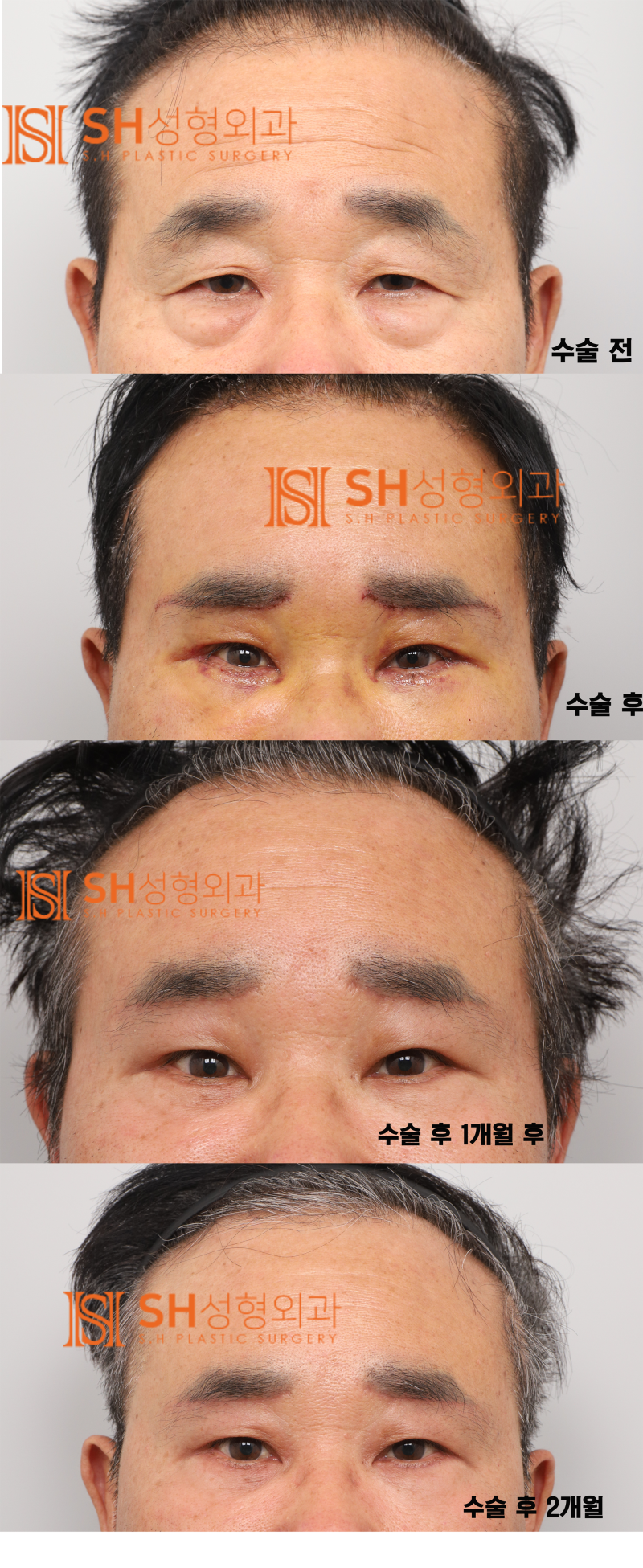 #28 60대 남자 눈성형, 눈물 흘림 이유_ 중년 남자 복합 리프팅 케이스 사진 9