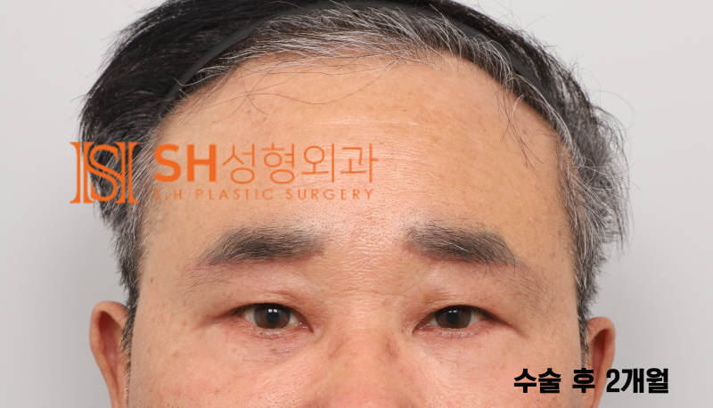 #28 60대 남자 눈성형, 눈물 흘림 이유_ 중년 남자 복합 리프팅 케이스 사진 6