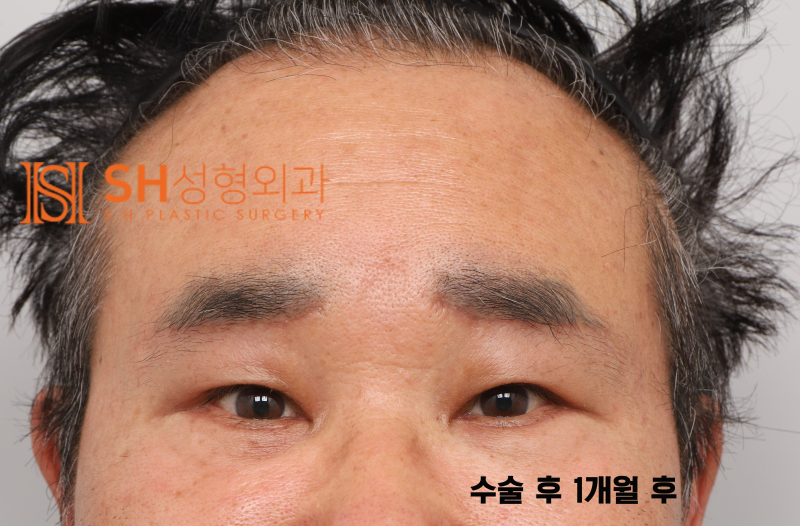 #28 60대 남자 눈성형, 눈물 흘림 이유_ 중년 남자 복합 리프팅 케이스 사진 5