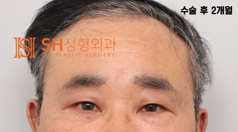 #28 60대 남자 눈성형, 눈물 흘림 이유_ 중년 남자 복합 리프팅 케이스 사진 7