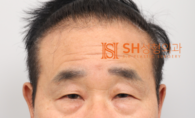 #28 60대 남자 눈성형, 눈물 흘림 이유_ 중년 남자 복합 리프팅 케이스 사진 2