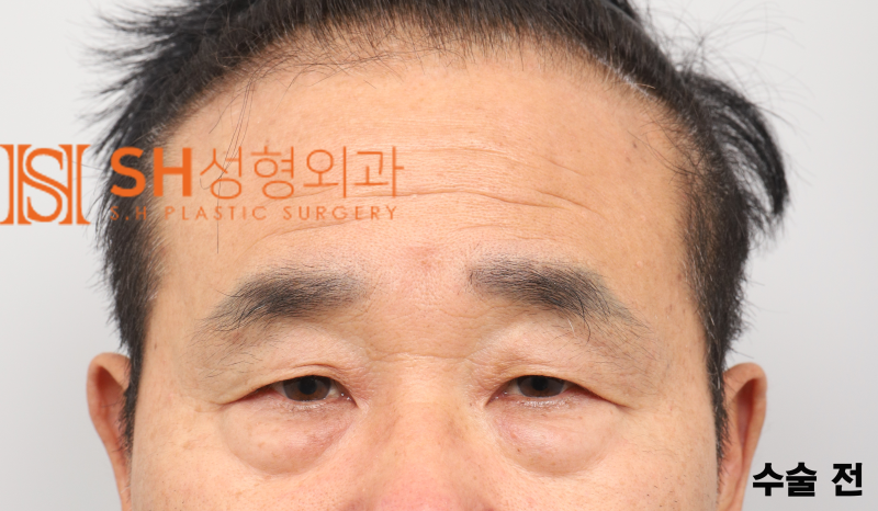 #28 60대 남자 눈성형, 눈물 흘림 이유_ 중년 남자 복합 리프팅 케이스 사진 3