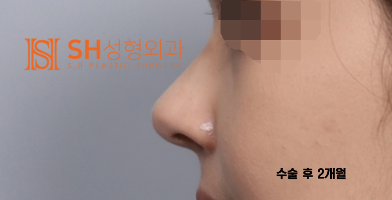 #29 콧볼축소 vs 긴코수술 , 코끝수술은 어떻게 결정해야할까? _ 코끝수술 후기, 코끝수술 회복까지 SH성형외과 에스에이치성형외과