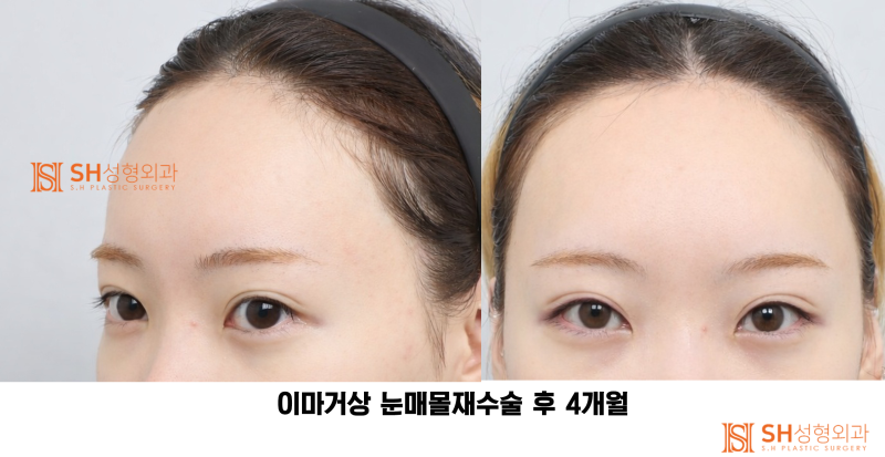 #30 눈썹 눈 사이 거리 좁아 보인다면? 내시경 이마거상과 매몰쌍꺼풀 재수술이 함께 필요한 경우 SH성형외과 에스에이치성형외과