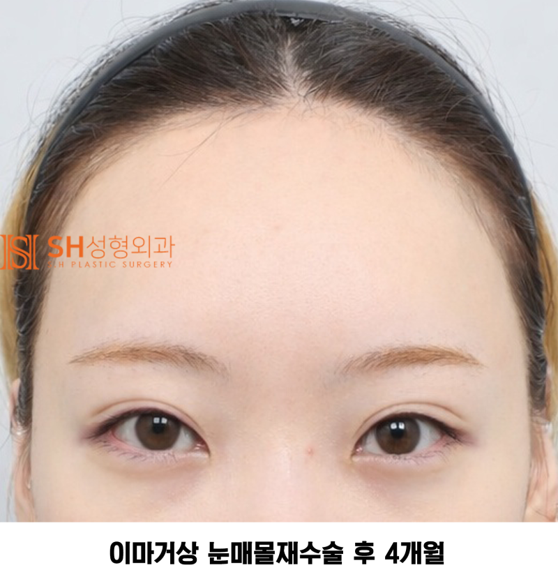 #30 눈썹 눈 사이 거리 좁아 보인다면? 내시경 이마거상과 매몰쌍꺼풀 재수술이 함께 필요한 경우 SH성형외과 에스에이치성형외과 사진 5