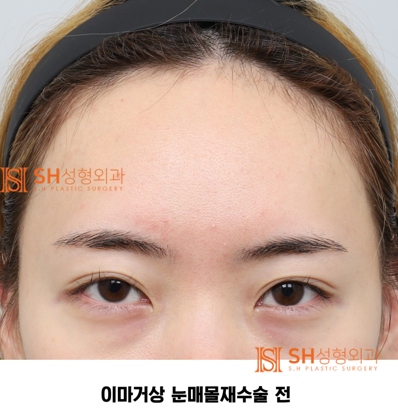 #30 눈썹 눈 사이 거리 좁아 보인다면? 내시경 이마거상과 매몰쌍꺼풀 재수술이 함께 필요한 경우 SH성형외과 에스에이치성형외과 사진 3