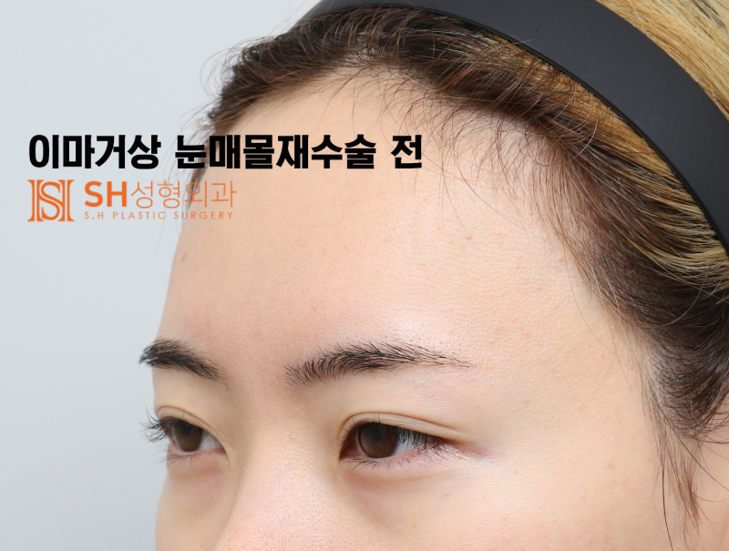 #30 눈썹 눈 사이 거리 좁아 보인다면? 내시경 이마거상과 매몰쌍꺼풀 재수술이 함께 필요한 경우 SH성형외과 에스에이치성형외과 사진 2