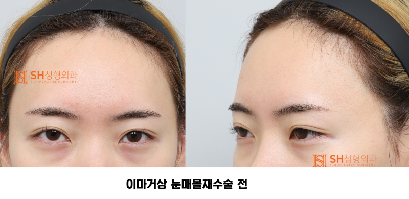 #30 눈썹 눈 사이 거리 좁아 보인다면? 내시경 이마거상과 매몰쌍꺼풀 재수술이 함께 필요한 경우 SH성형외과 에스에이치성형외과