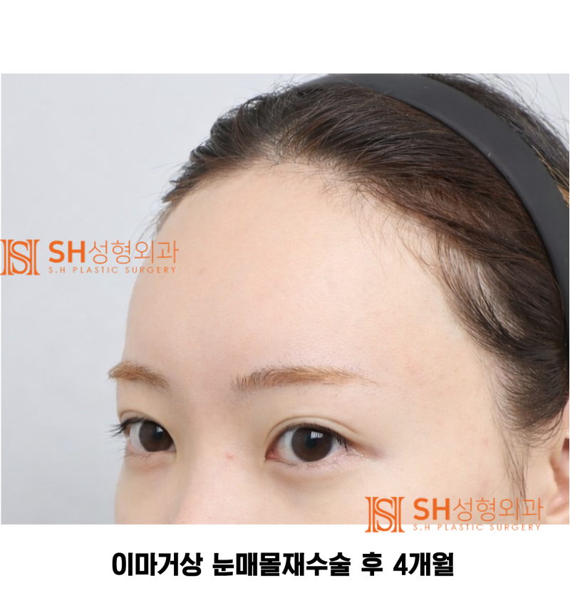 #30 눈썹 눈 사이 거리 좁아 보인다면? 내시경 이마거상과 매몰쌍꺼풀 재수술이 함께 필요한 경우 SH성형외과 에스에이치성형외과 사진 4
