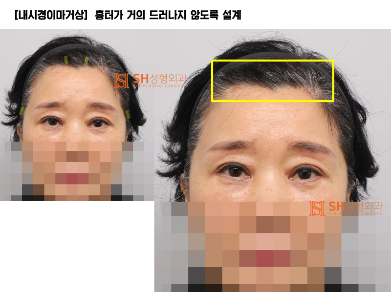 #31 내시경 이마거상 눈썹거상 매몰쌍꺼풀 하안검+중안면거상_상안면부터 중안면까지 ‘하나의 흐름’으로 설계하는 이유 SH성형외과 에스에이치성형외과 사진 10