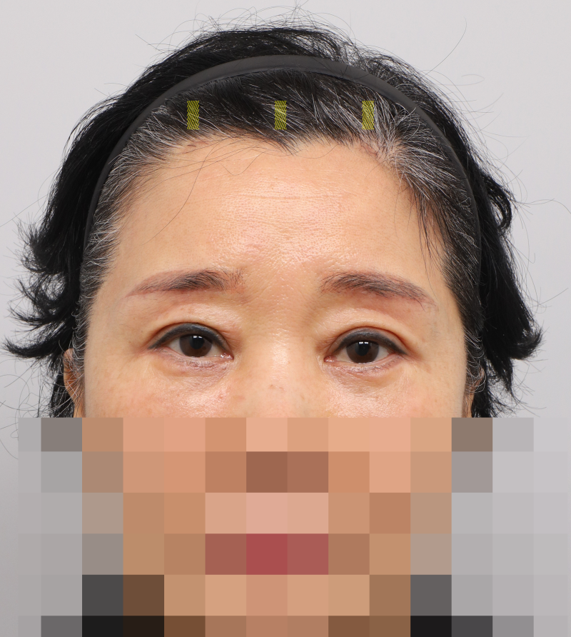 #31상안면부터 중안면까지 함께 설계해야 하는 이유! 내시경 이마거상 눈썹거상 매몰쌍꺼풀 하안검 중안면거상, 하나의 얼굴 디자인 SH성형외과 에스에이치성형외과 사진 8