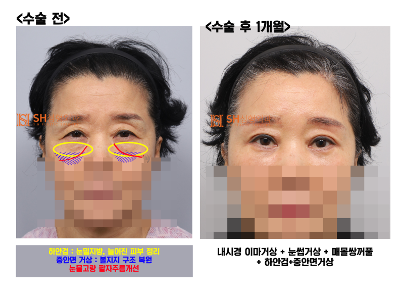 #31상안면부터 중안면까지 함께 설계해야 하는 이유! 내시경 이마거상 눈썹거상 매몰쌍꺼풀 하안검 중안면거상, 하나의 얼굴 디자인 SH성형외과 에스에이치성형외과 사진 6
