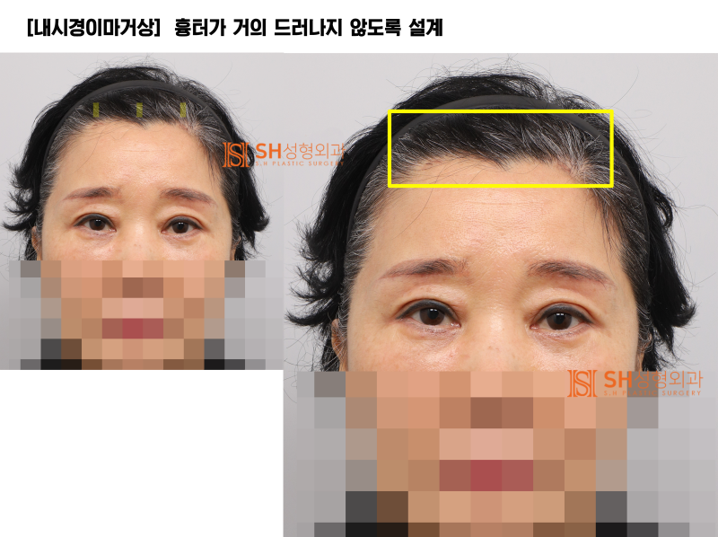 #31상안면부터 중안면까지 함께 설계해야 하는 이유! 내시경 이마거상 눈썹거상 매몰쌍꺼풀 하안검 중안면거상, 하나의 얼굴 디자인 SH성형외과 에스에이치성형외과 사진 9