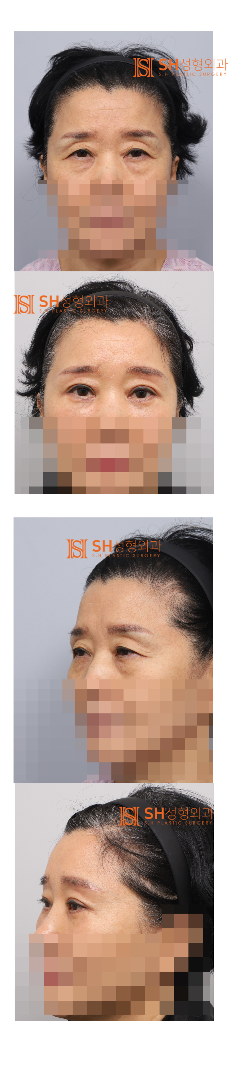 #31상안면부터 중안면까지 함께 설계해야 하는 이유! 내시경 이마거상 눈썹거상 매몰쌍꺼풀 하안검 중안면거상, 하나의 얼굴 디자인 SH성형외과 에스에이치성형외과 사진 11