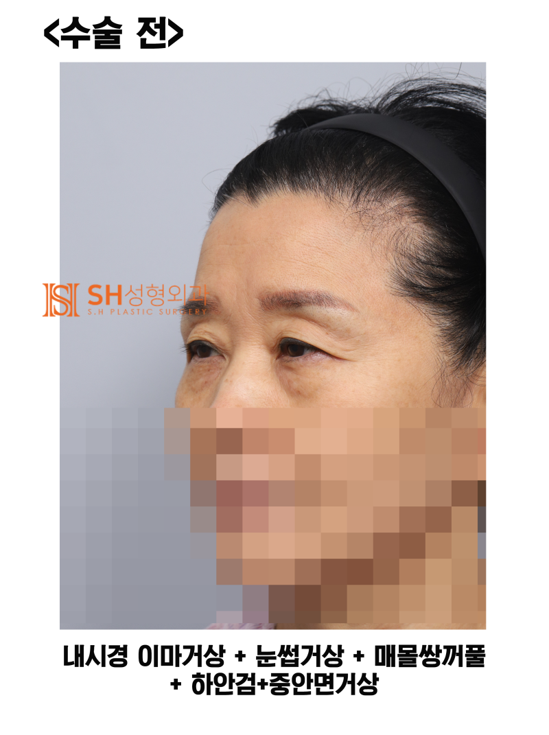 #31상안면부터 중안면까지 함께 설계해야 하는 이유! 내시경 이마거상 눈썹거상 매몰쌍꺼풀 하안검 중안면거상, 하나의 얼굴 디자인 SH성형외과 에스에이치성형외과 사진 2