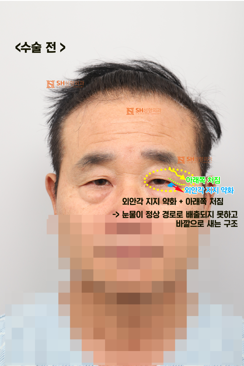 60대 남성 눈물흐름·눈가처짐, 엔도타인 내시경이마거상과 하안검·중안면거상, 눈썹하거상이 함께 필요한 이유_SH성형외과 에스에이치성형외과 사진 2