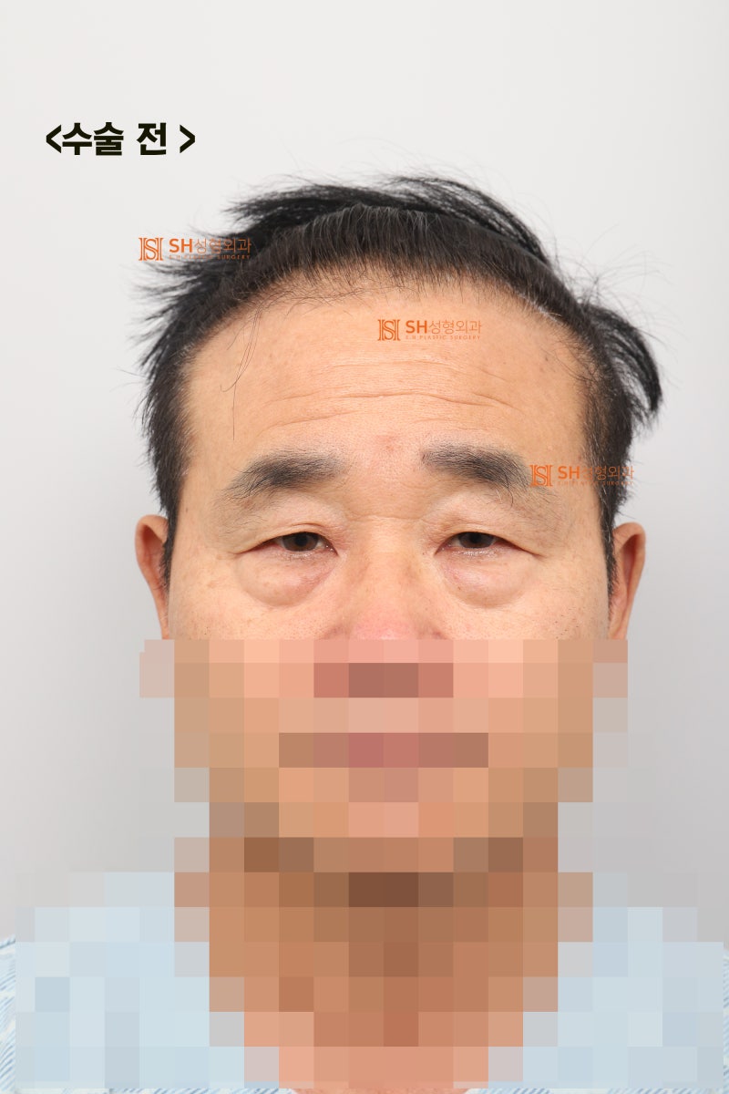 60대 남성 눈물흐름·눈가처짐, 엔도타인 내시경이마거상과 하안검·중안면거상, 눈썹하거상이 함께 필요한 이유_SH성형외과 에스에이치성형외과