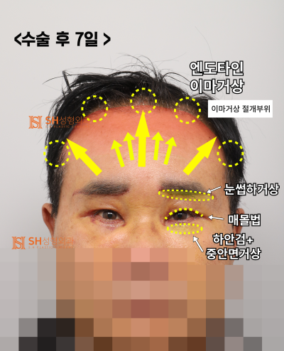 60대 남성 눈물흐름·눈가처짐, 엔도타인 내시경이마거상과 하안검·중안면거상, 눈썹하거상이 함께 필요한 이유_SH성형외과 에스에이치성형외과 사진 7