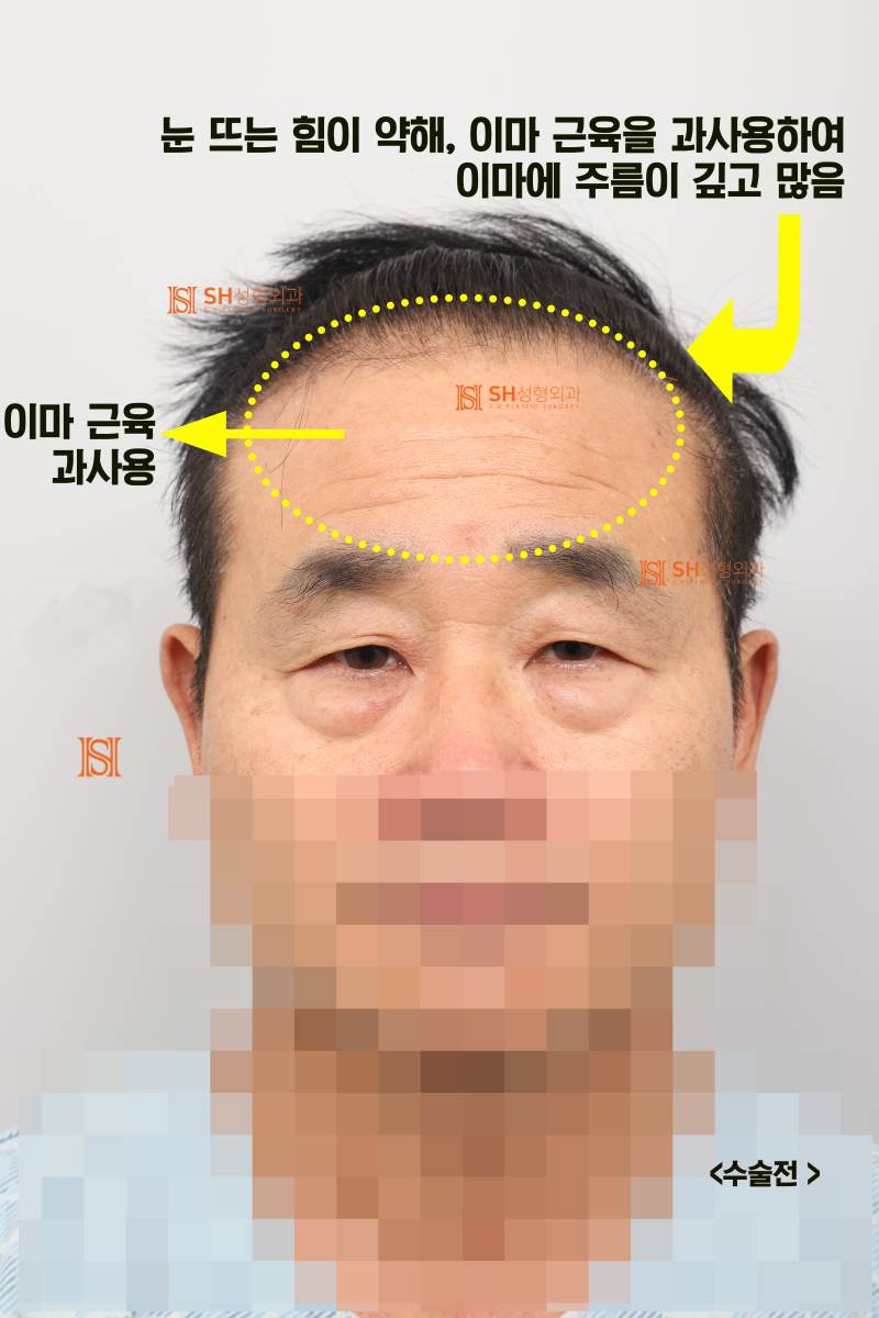 60대 남성 눈물흐름·눈가처짐, 엔도타인 내시경이마거상과 하안검·중안면거상, 눈썹하거상이 함께 필요한 이유_SH성형외과 에스에이치성형외과 사진 3