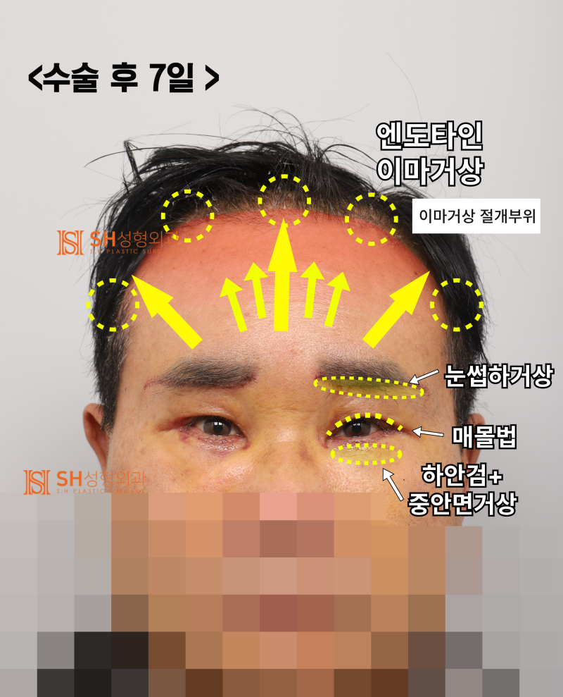 60대 남성 눈물흐름·눈가처짐, 엔도타인 내시경이마거상과 하안검·중안면거상, 눈썹하거상이 함께 필요한 이유_SH성형외과 에스에이치성형외과 사진 5