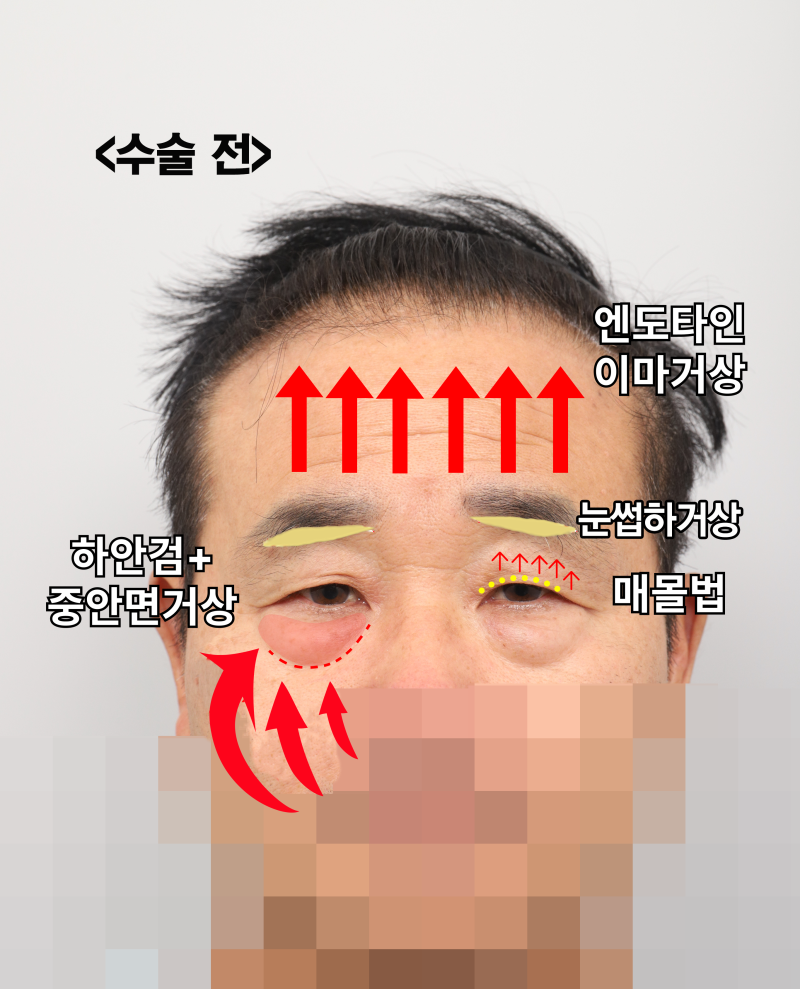 60대 남성 눈물흐름·눈가처짐, 엔도타인 내시경이마거상과 하안검·중안면거상, 눈썹하거상이 함께 필요한 이유_SH성형외과 에스에이치성형외과 사진 4