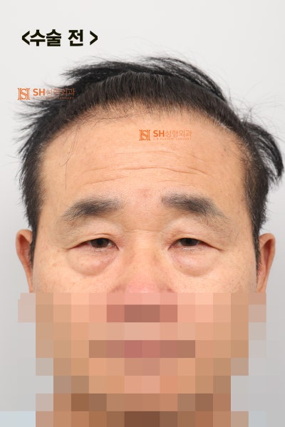 60대 남성 눈물흐름·눈가처짐, 엔도타인 내시경이마거상과 하안검·중안면거상, 눈썹하거상이 함께 필요한 이유_SH성형외과 에스에이치성형외과 사진 8