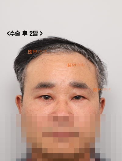 60대 남성 눈물흐름·눈가처짐, 엔도타인 내시경이마거상과 하안검·중안면거상, 눈썹하거상이 함께 필요한 이유_SH성형외과 에스에이치성형외과 사진 11