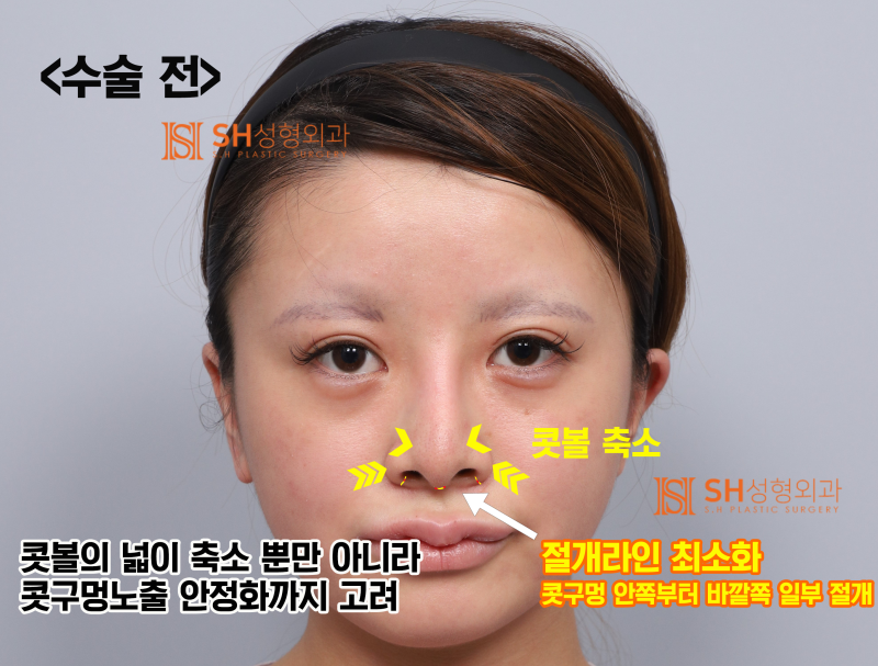 코재수술 후기, 코수술 후 콧볼이 더 넓어 보인다면? 실리콘 교체와 콧볼축소가 함께 필요한 이유. SH성형외과 에스에이치성형외과 사진 6