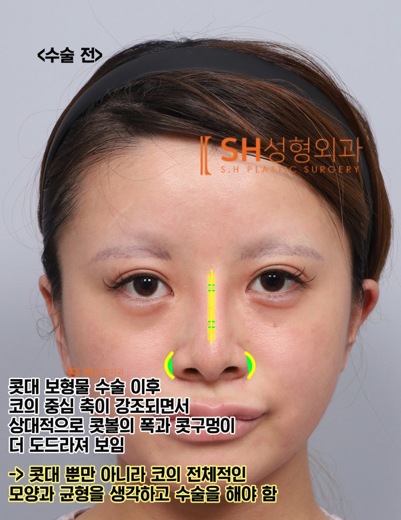 코재수술 후기, 코수술 후 콧볼이 더 넓어 보인다면? 실리콘 교체와 콧볼축소가 함께 필요한 이유. SH성형외과 에스에이치성형외과 사진 5