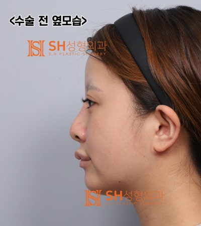 코재수술 후기, 코수술 후 콧볼이 더 넓어 보인다면? 실리콘 교체와 콧볼축소가 함께 필요한 이유. SH성형외과 에스에이치성형외과 사진 3