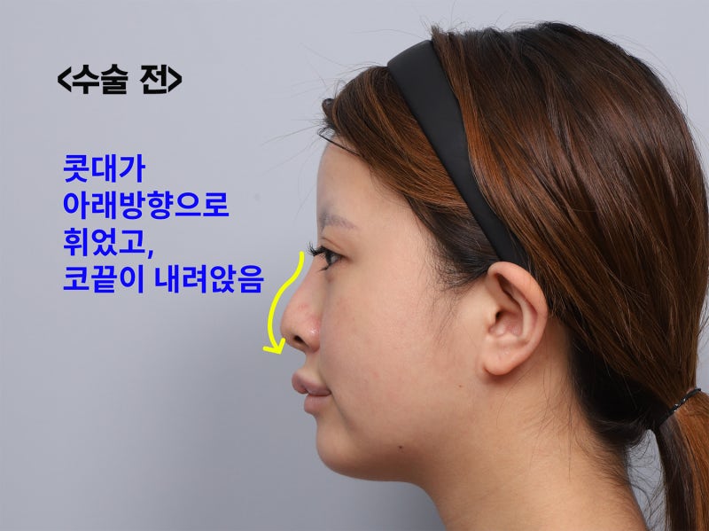 코재수술 후기, 코수술 후 콧볼이 더 넓어 보인다면? 실리콘 교체와 콧볼축소가 함께 필요한 이유. SH성형외과 에스에이치성형외과 사진 7