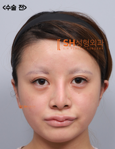 코재수술 후기, 코수술 후 콧볼이 더 넓어 보인다면? 실리콘 교체와 콧볼축소가 함께 필요한 이유. SH성형외과 에스에이치성형외과