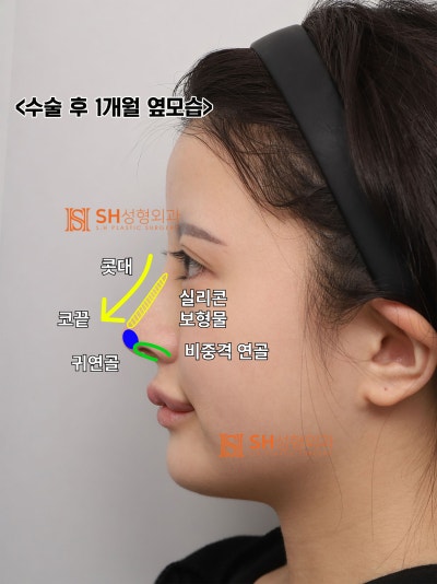 코재수술 후기, 코수술 후 콧볼이 더 넓어 보인다면? 실리콘 교체와 콧볼축소가 함께 필요한 이유. SH성형외과 에스에이치성형외과 사진 9
