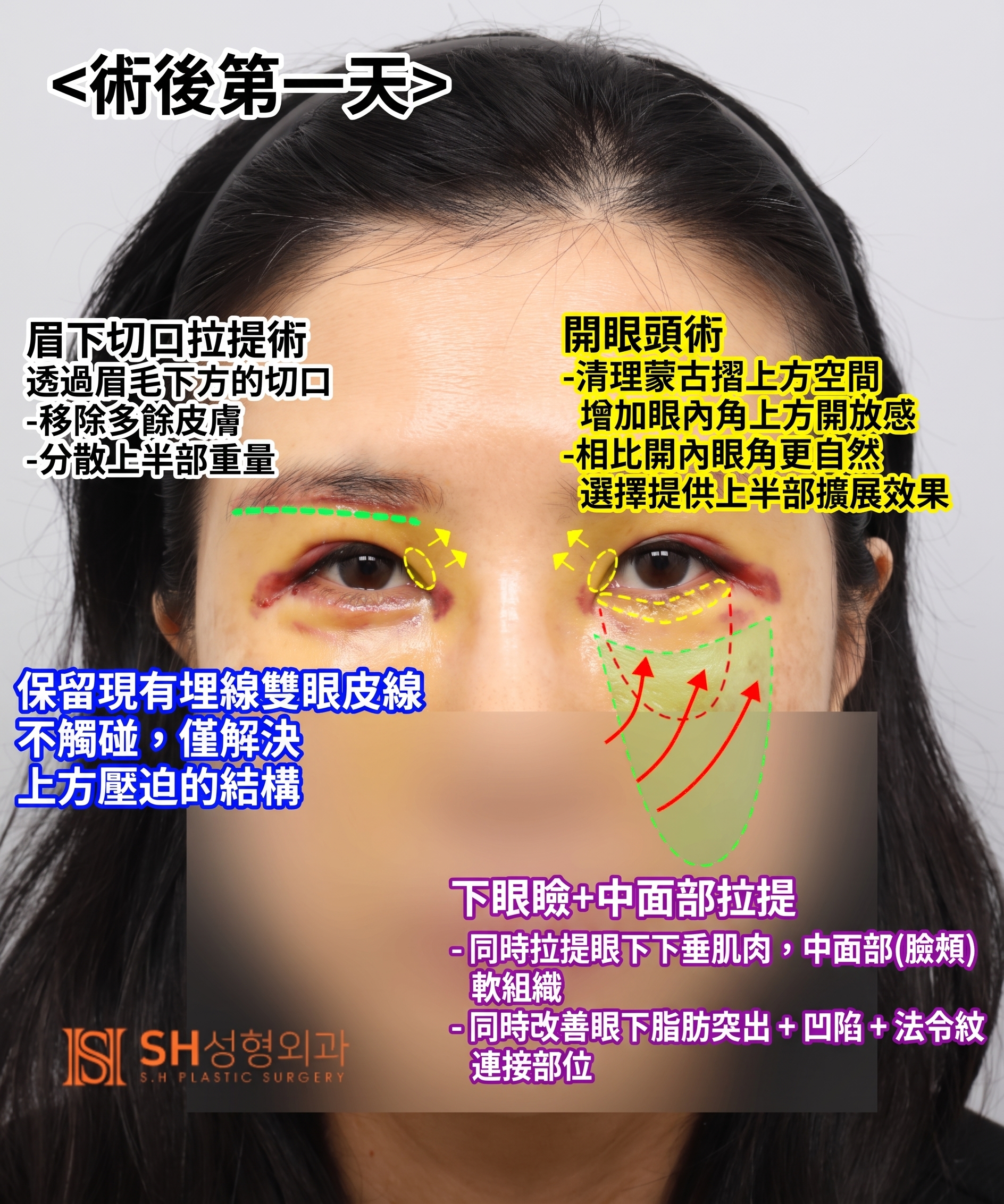 雙眼皮重修不如先做內視鏡提眉?|Endotine內視鏡提眉實際案例 SH整形外科 사진 5