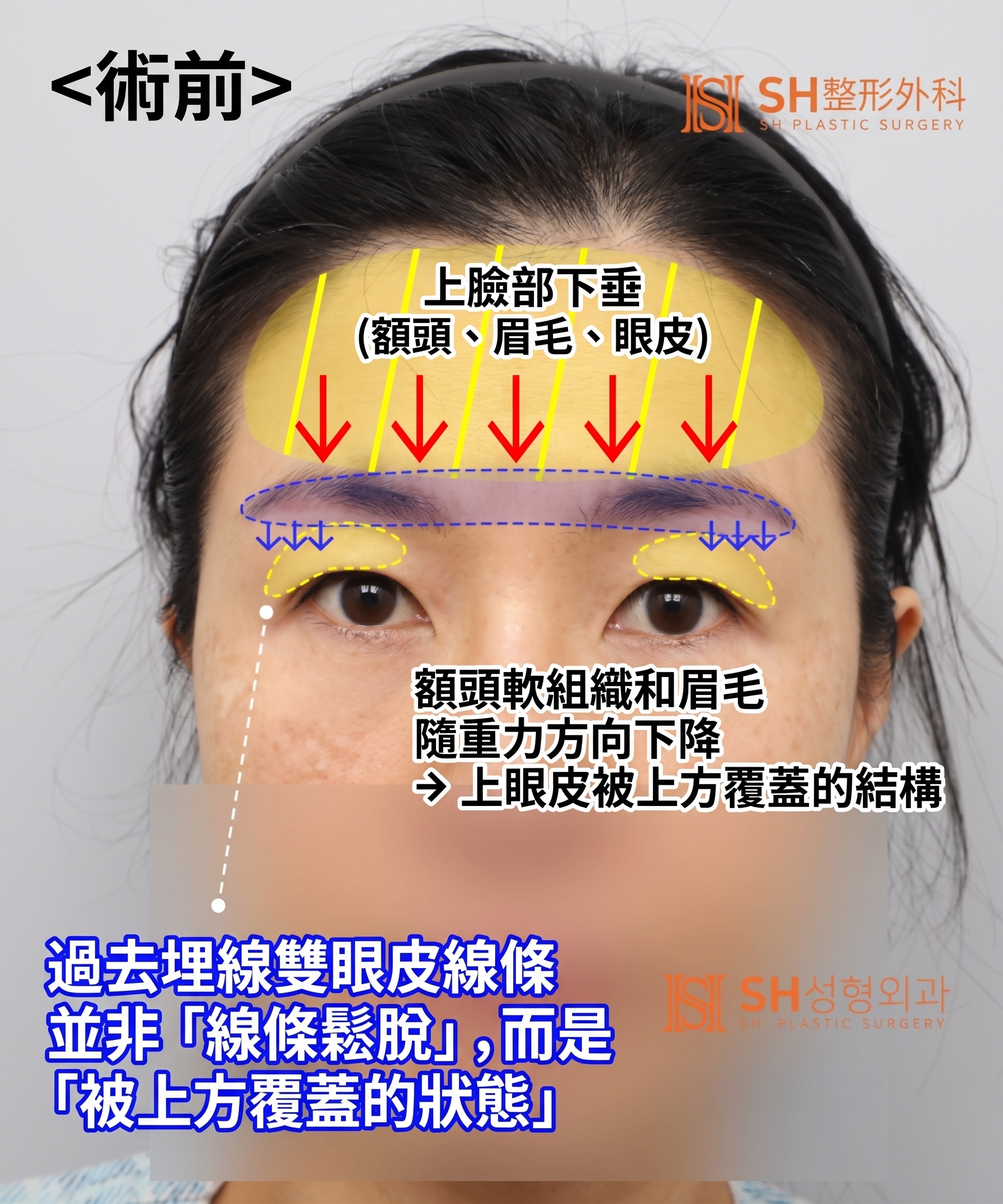 雙眼皮重修不如先做內視鏡提眉?|Endotine內視鏡提眉實際案例 SH整形外科 사진 9