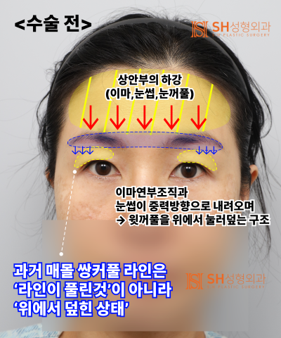 쌍꺼풀 재수술이 아닌 이마거상이 먼저였던 이유|엔도타인 내시경 이마거상 실제 사례 SH성형외과 에스에이치성형외과 사진 9