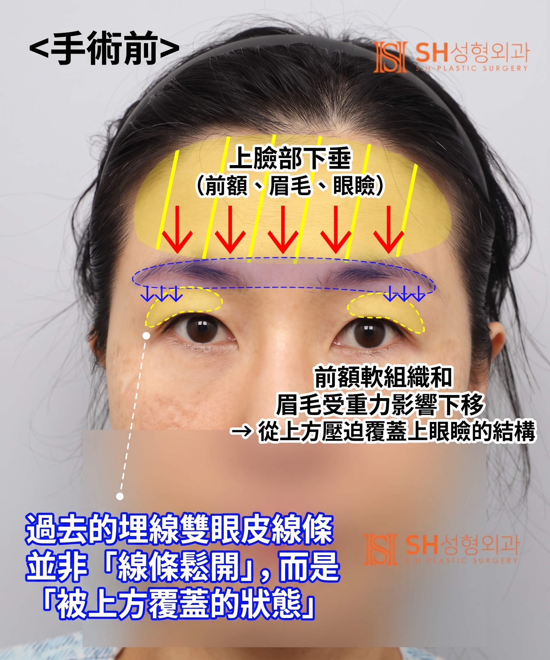 雙眼皮重修不如先做內視鏡提眉?|Endotine內視鏡提眉實際案例 SH整形外科 사진 3