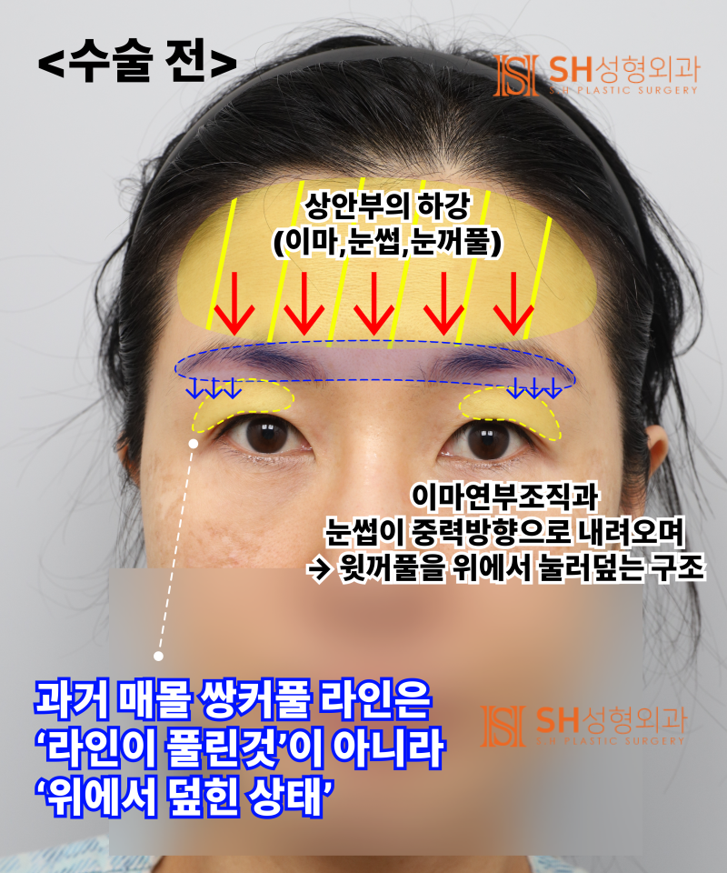 쌍꺼풀 재수술이 아닌 이마거상이 먼저였던 이유|엔도타인 내시경 이마거상 실제 사례 SH성형외과 에스에이치성형외과 사진 3