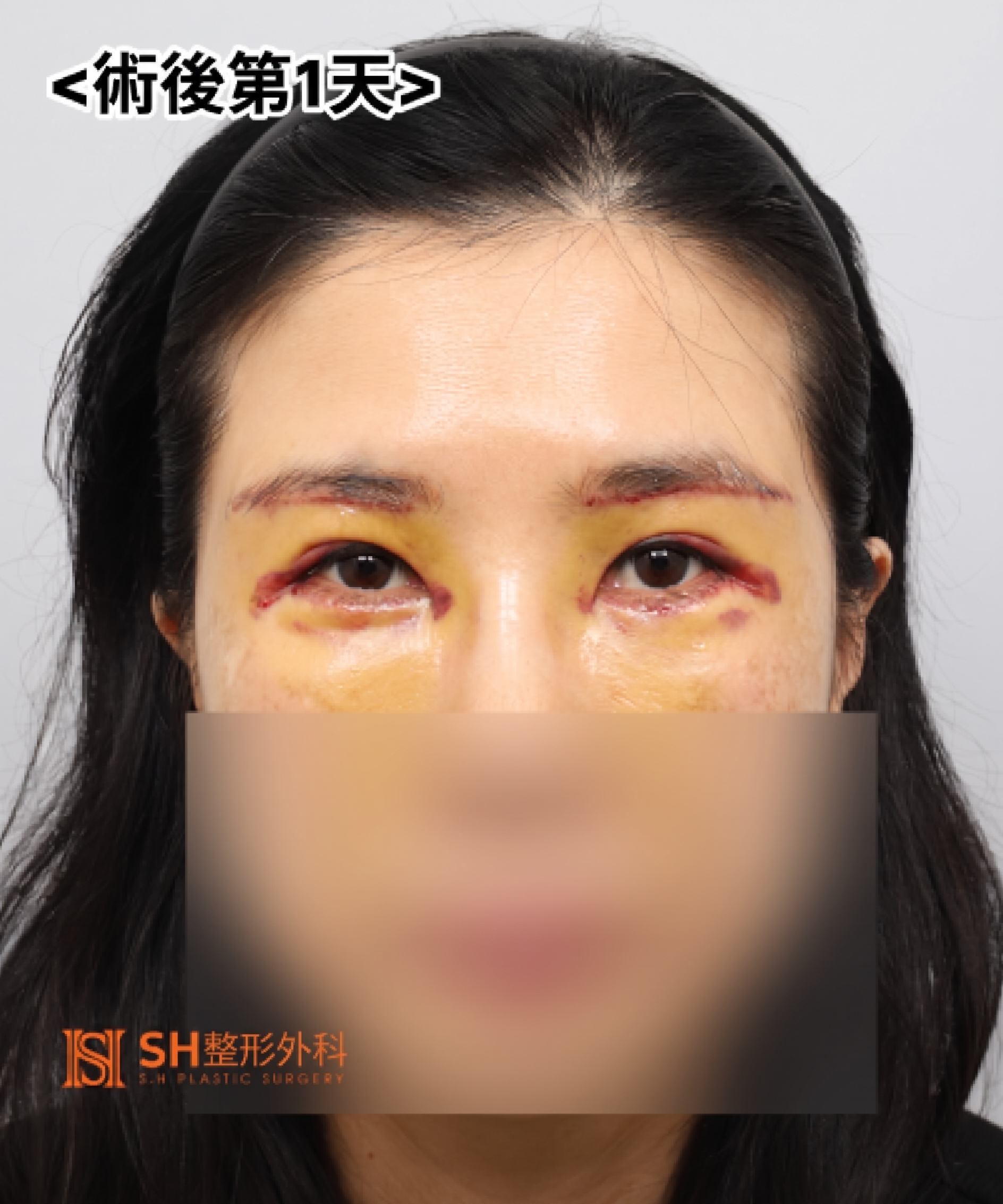 雙眼皮重修不如先做內視鏡提眉?|Endotine內視鏡提眉實際案例 SH整形外科 사진 15