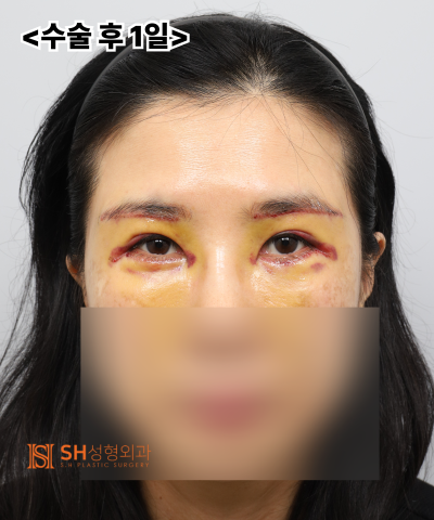 쌍꺼풀 재수술이 아닌 이마거상이 먼저였던 이유|엔도타인 내시경 이마거상 실제 사례 SH성형외과 에스에이치성형외과 사진 15