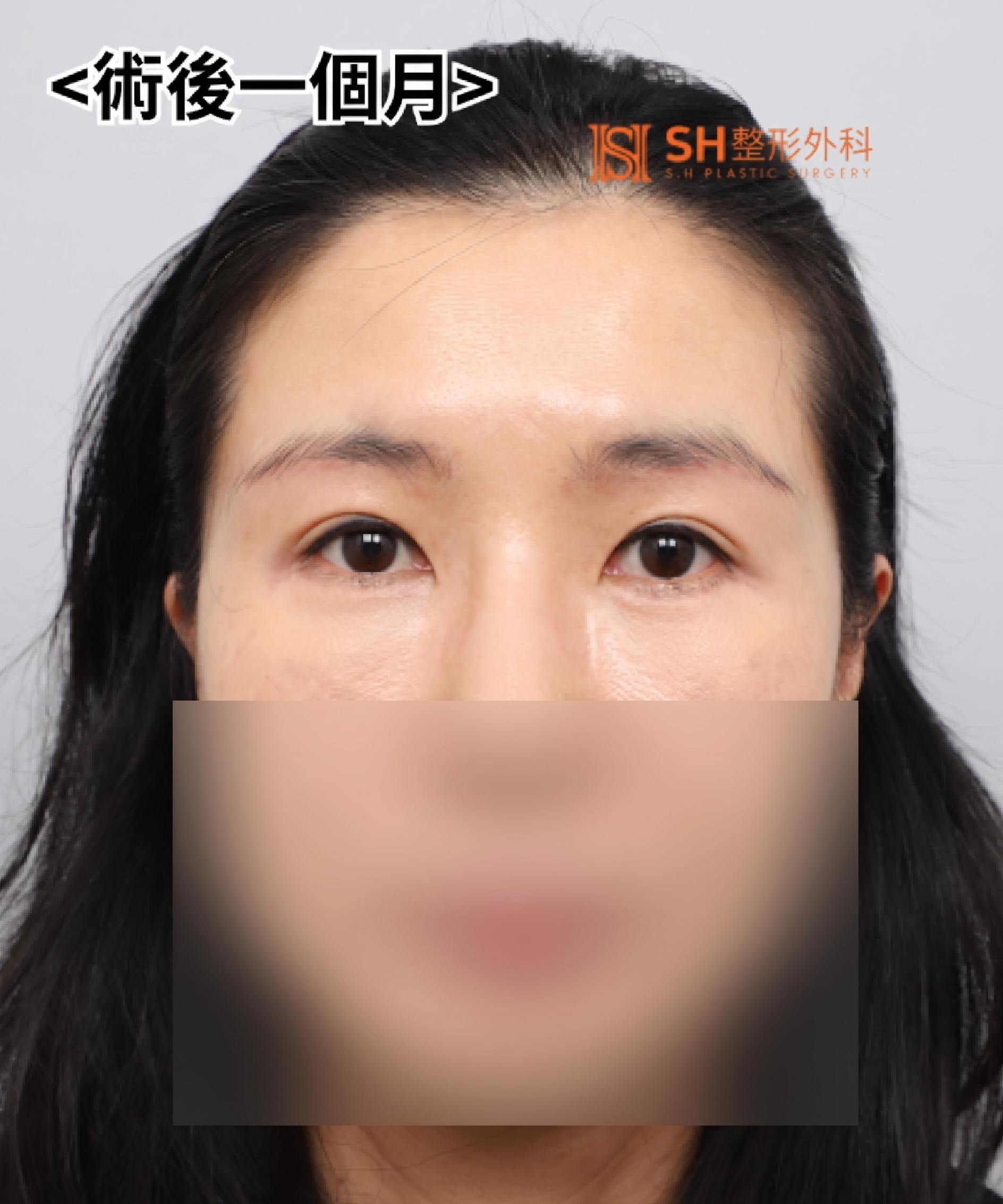雙眼皮重修不如先做內視鏡提眉?|Endotine內視鏡提眉實際案例 SH整形外科 사진 8