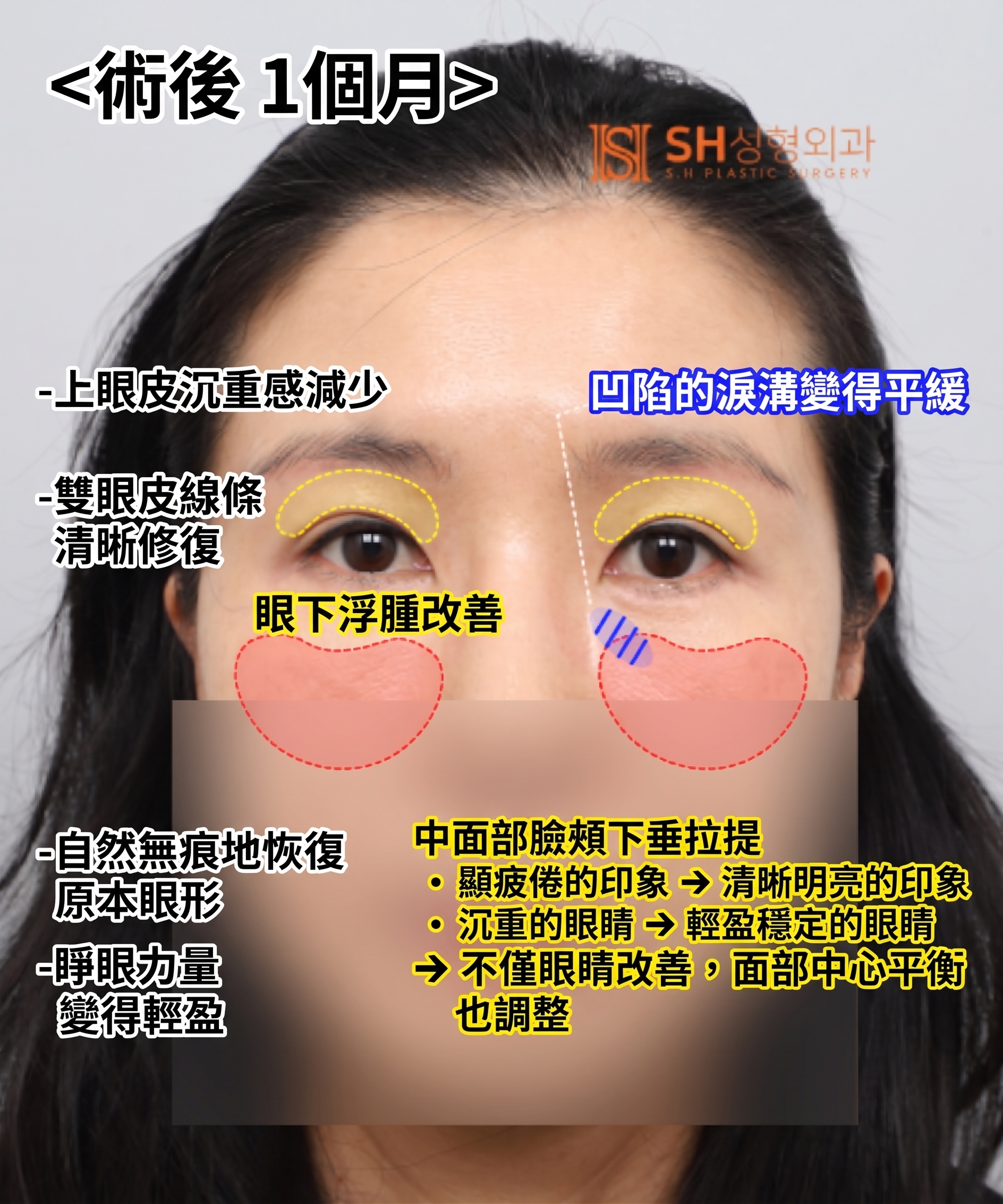 雙眼皮重修不如先做內視鏡提眉?|Endotine內視鏡提眉實際案例 SH整形外科 사진 12