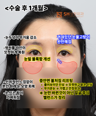 쌍꺼풀 재수술이 아닌 이마거상이 먼저였던 이유|엔도타인 내시경 이마거상 실제 사례 SH성형외과 에스에이치성형외과 사진 12