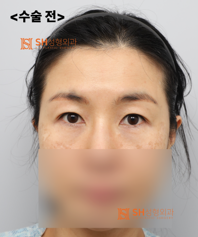쌍꺼풀 재수술이 아닌 이마거상이 먼저였던 이유|엔도타인 내시경 이마거상 실제 사례 SH성형외과 에스에이치성형외과 사진 7