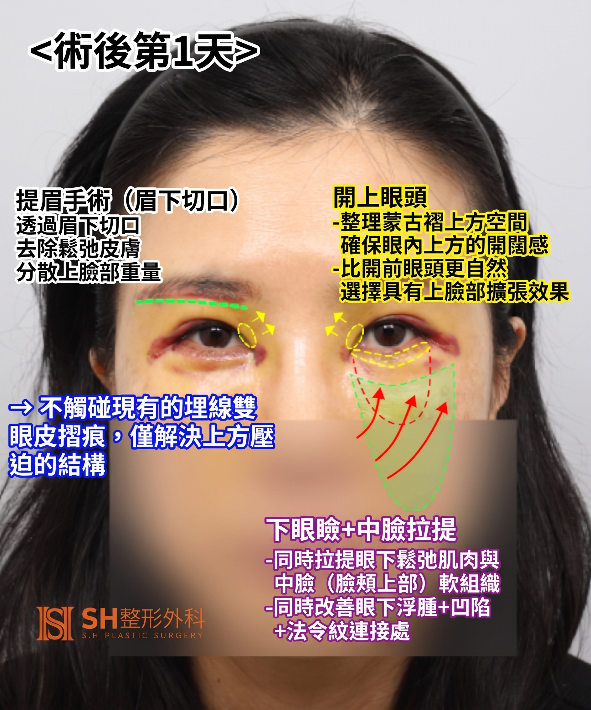 雙眼皮重修不如先做內視鏡提眉?|Endotine內視鏡提眉實際案例 SH整形外科 사진 11