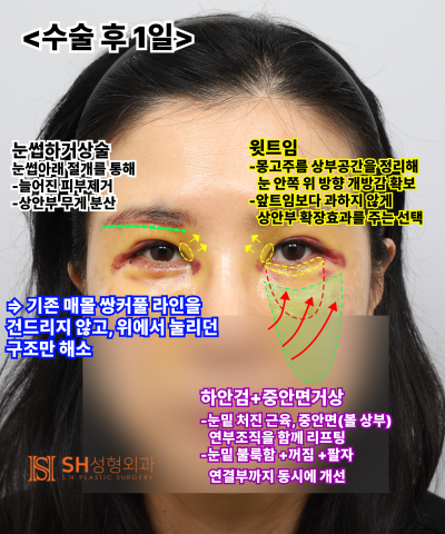 쌍꺼풀 재수술이 아닌 이마거상이 먼저였던 이유|엔도타인 내시경 이마거상 실제 사례 SH성형외과 에스에이치성형외과 사진 11