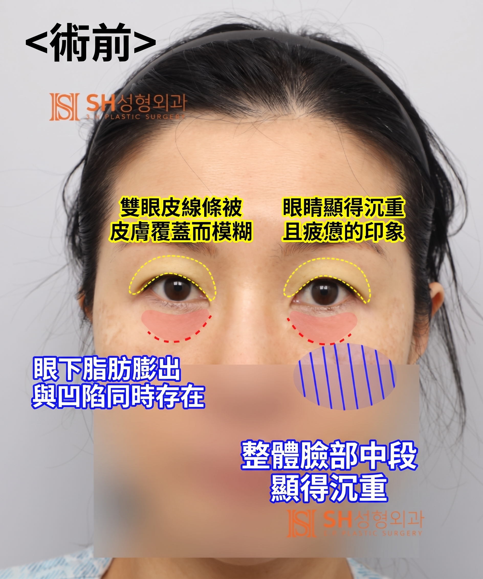 雙眼皮重修不如先做內視鏡提眉?|Endotine內視鏡提眉實際案例 SH整形外科 사진 10