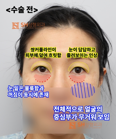 쌍꺼풀 재수술이 아닌 이마거상이 먼저였던 이유|엔도타인 내시경 이마거상 실제 사례 SH성형외과 에스에이치성형외과 사진 10